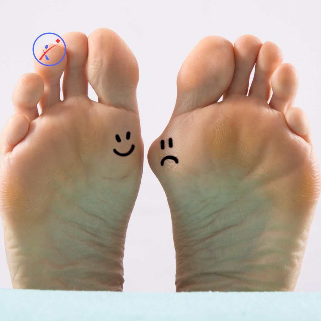 Na fotografiji je jasen prikaz zdravega in deformiranega sklepa palcev nog. Gre za prikaz tipične podobe deformacije imenovane hallux valgus.
